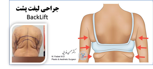 جراحی لیفت پشت – لیفت زیر خط سوتین