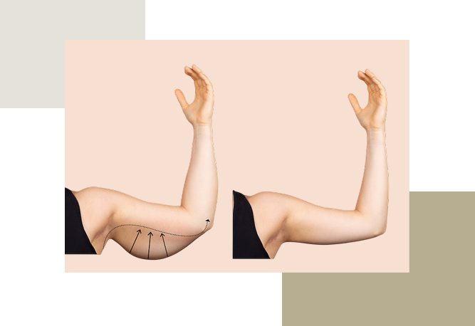 لیفت بازو و لیپوساکشن