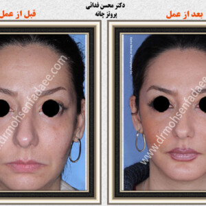 پروتز های صورت