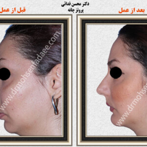 پروتز های صورت