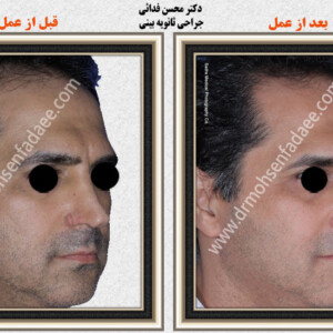 جراحی بینی جراحی بینی