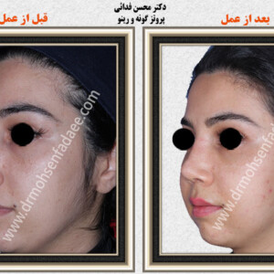 پروتز های صورت و گونه