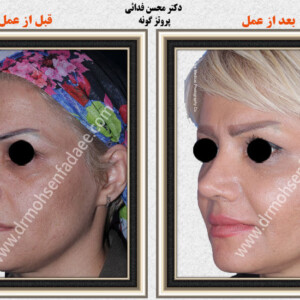 پروتز های صورت پروتز های صورت