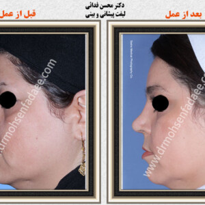 جراحی بینی استخوانی