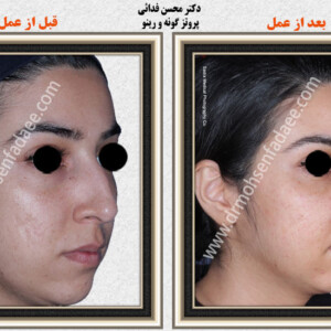 پروتز های صورت و گونه