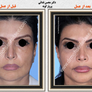 پروتز های صورت پروتز های صورت
