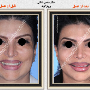 پروتز های صورت پروتز های صورت
