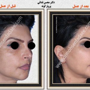 پروتز های صورت پروتز های صورت