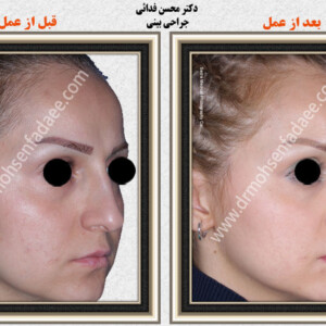 جراحی بینی جراحی بینی