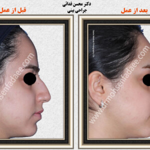 جراحی بینی جراحی بینی