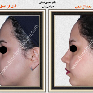 جراحی بینی جراحی بینی