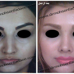 جراحی بینی جراحی بینی