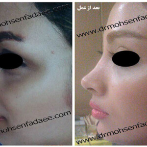 جراحی بینی جراحی بینی