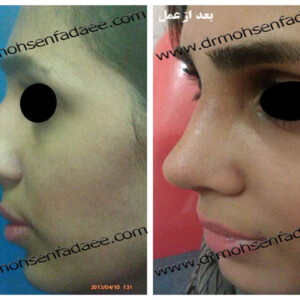 جراحی بینی جراحی بینی