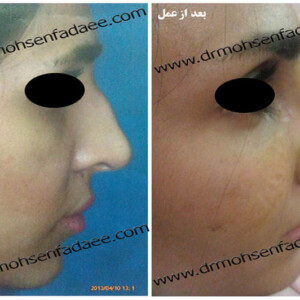 جراحی بینی جراحی بینی