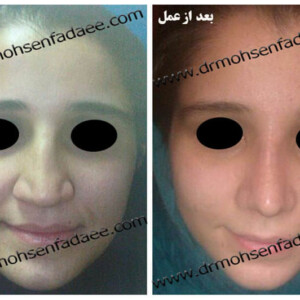 جراحی بینی جراحی بینی