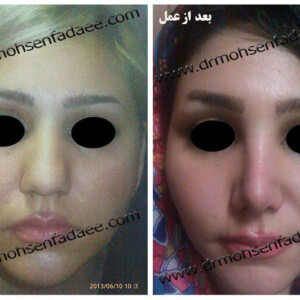 جراحی بینی جراحی بینی