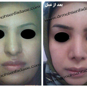 جراحی بینی جراحی بینی