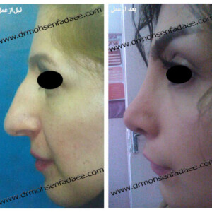 جراحی بینی جراحی بینی