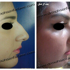 جراحی بینی جراحی بینی