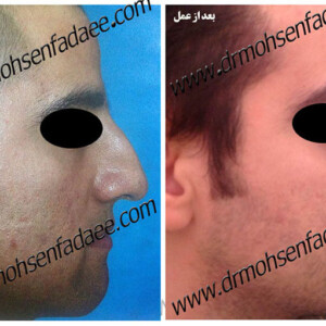 جراحی بینی جراحی بینی
