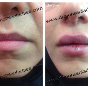 تزریق بوتاکس و ژل تزریق بوتاکس و ژل