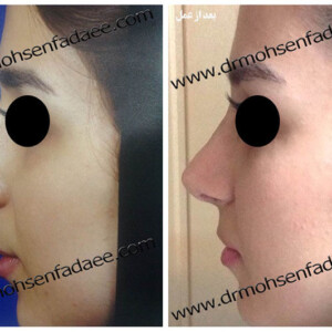 جراحی بینی جراحی بینی