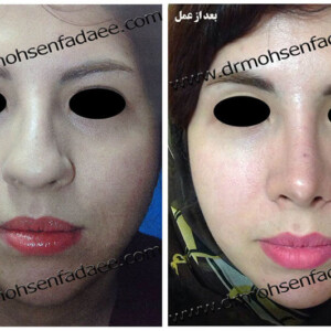 جراحی بینی جراحی بینی