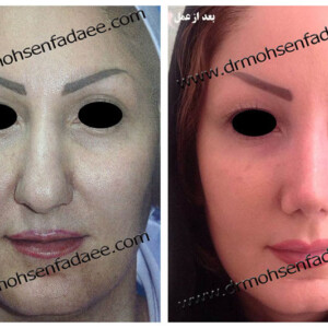 جراحی بینی جراحی بینی