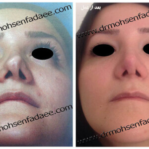 جراحی بینی جراحی بینی