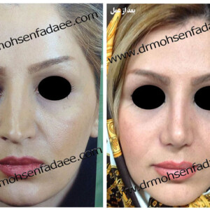 جراحی بینی جراحی بینی