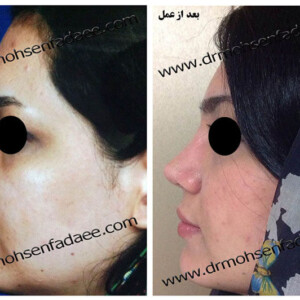 جراحی بینی جراحی بینی