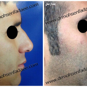 جراحی بینی جراحی بینی