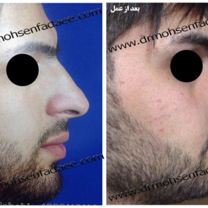 جراحی بینی جراحی بینی