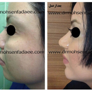 جراحی بینی جراحی بینی