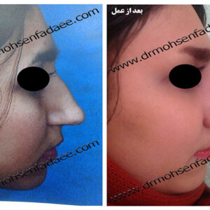 جراحی بینی جراحی بینی