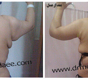 لیپوماتیک لیپوماتیک