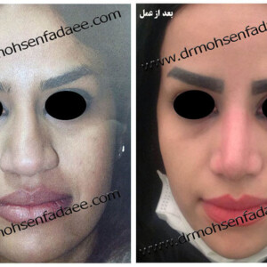 جراحی بینی جراحی بینی