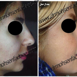 جراحی بینی جراحی بینی