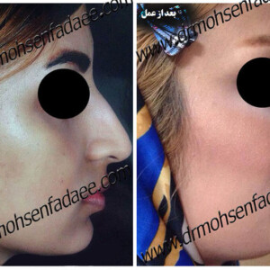 جراحی بینی جراحی بینی