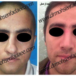 جراحی بینی جراحی بینی