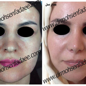 جراحی بینی جراحی بینی