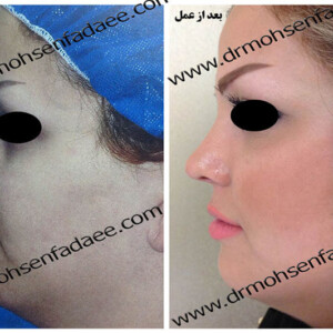 جراحی بینی جراحی بینی