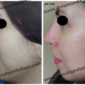 جراحی بینی جراحی بینی