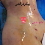 لیپوماتیک - پیکرتراشی