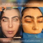 لیفت ابرو و پیشانی بدون اندوتاین