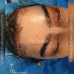 لیفت ابرو و پیشانی بدون اندوتاین