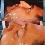 جراحی بینی