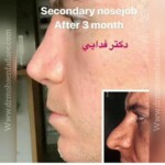 جراحی بینی