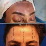 لیفت ابرو